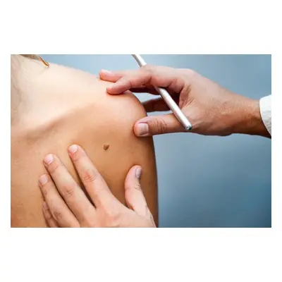 Two areas, mole sunspot or skin tag removal