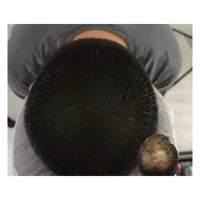 Hair-thinning contour tattoo 1 session