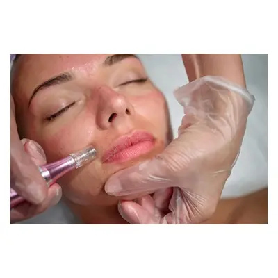 Deluxe Microneedling session with medical-grade mesotherapy serum