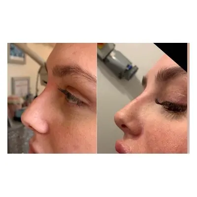 One ml Liquid Rhinoplasty Nose Dermal Filler