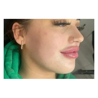 0.5ml Lip Filler