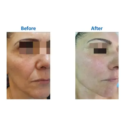 Two Radio-Frequency Skin-Tightening Treatments