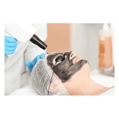 Three Sessions of Carbon Laser Peel Facial