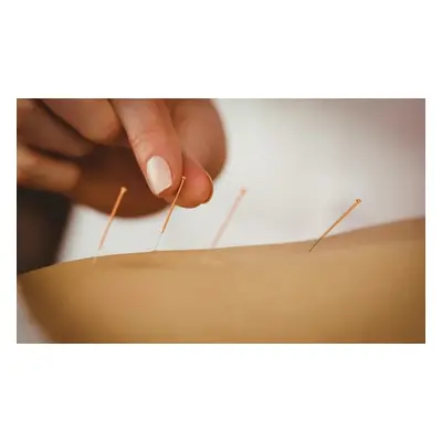 Acupuncture session with consultation massage and hot cupping (face or body); New customer