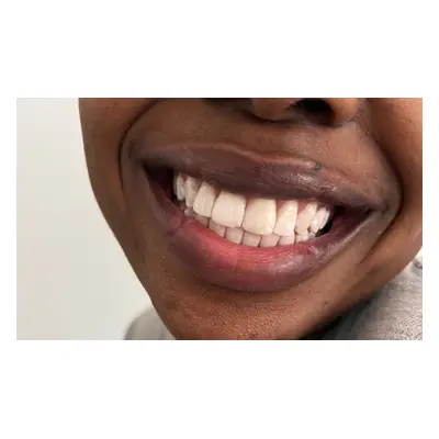 60 Minute Laser Teeth Whitening Session with Top Up