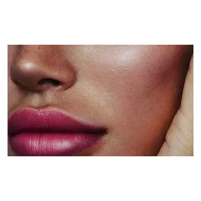 1ml Dermal filler Lips or Cheeks