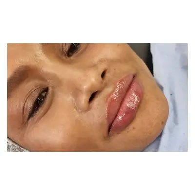 Dermal filler injections (1) ml - Lip