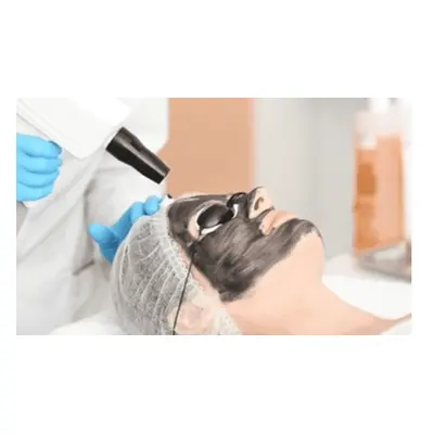 3 Sessions Carbon Peel Laser Facail