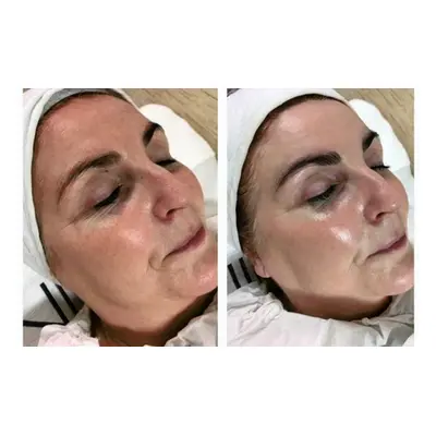 Chemical Peel