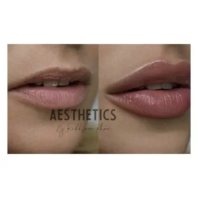 1.1ml Lip Filler