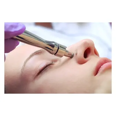 One Session Microdermabrasion