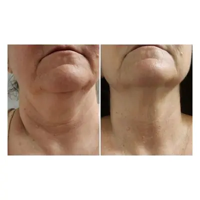 One Facial Skin Tightening & Décolletage