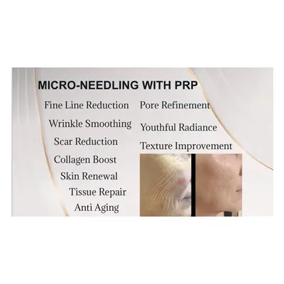 Micro-needling Treatment with PRP (one session)