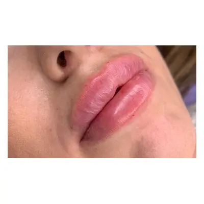 1.1ml lip filler