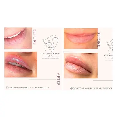 Expert 0.5ml Dermal Filler for Lips - Perfect Your Pout