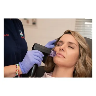 Morpheus8 Fractional Radiofrequency Microneedling Face or Neck