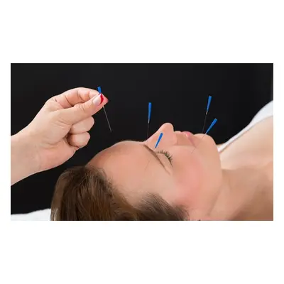 One-session Aesthetic Facial Acupuncture