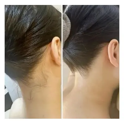 Small area, 6 sessions of laser hair removal