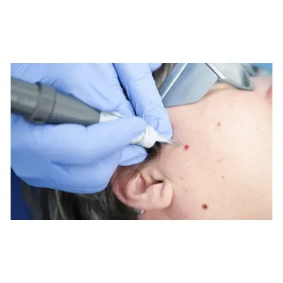 On one area, mole wart milia or skin tag removal