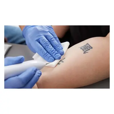 Three Sessions of Laser Tattoo Removal on a Large Area (16-20cm x 16-20cm)