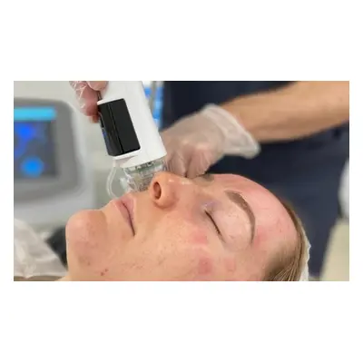 One Dermaforce Face (Radiofrequency Microneedling) Treatment