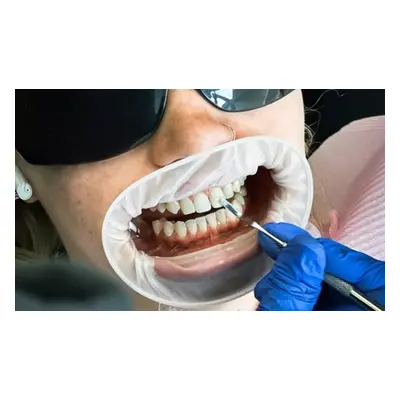 Dentist-led laser tooth whitening with Whitening Kit and customised trays