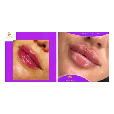 Advanced Dermal Filler with Consultation - 1.1ml