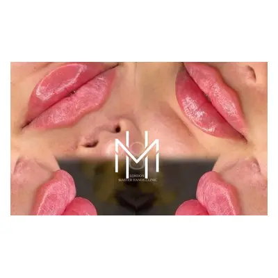 0.5ml Lip Filler Treatment