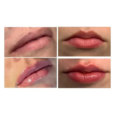 2ml Dermal Filler Treatment on lips with consultation