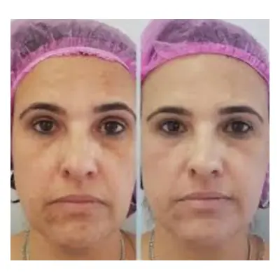 Micro-needling facial